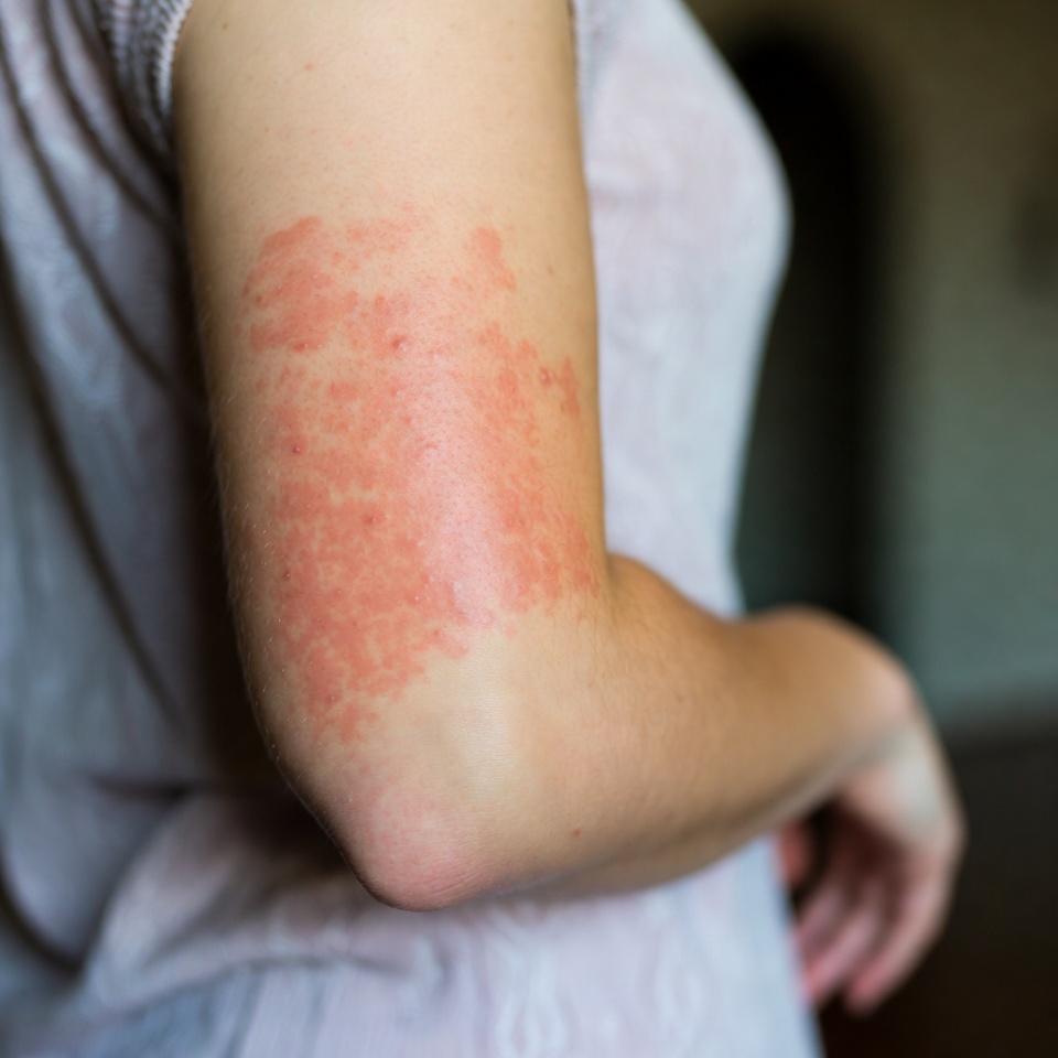 Consulta de dermatologia urgente online