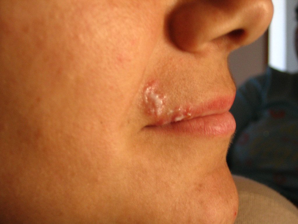 Herpes Labial