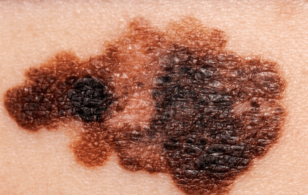 melanoma