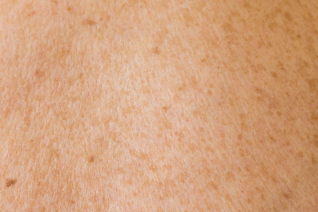 remoção de sinais dermatologia