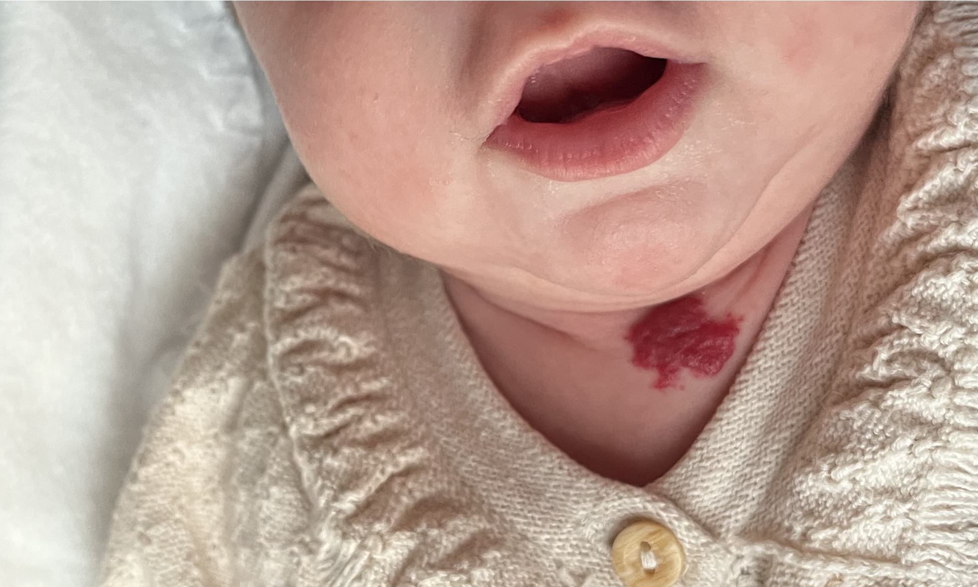 hemangioma infantil